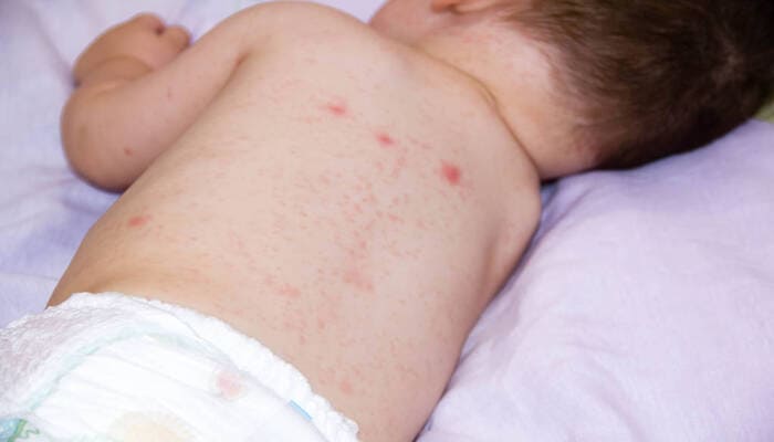 Симптомы и признаки атопического дерматита у детей.